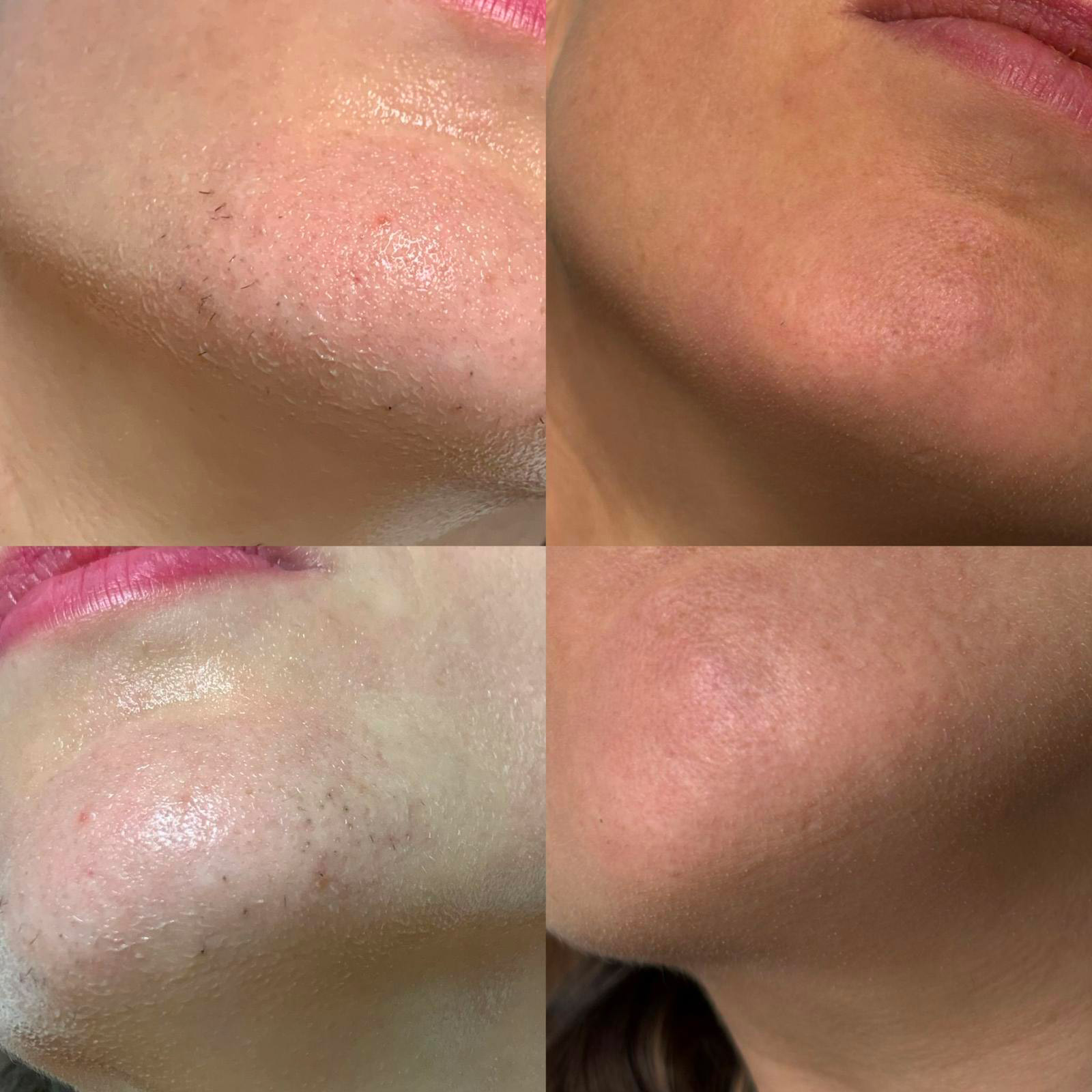 epilazionelaser-centrosuntime-primadopo01