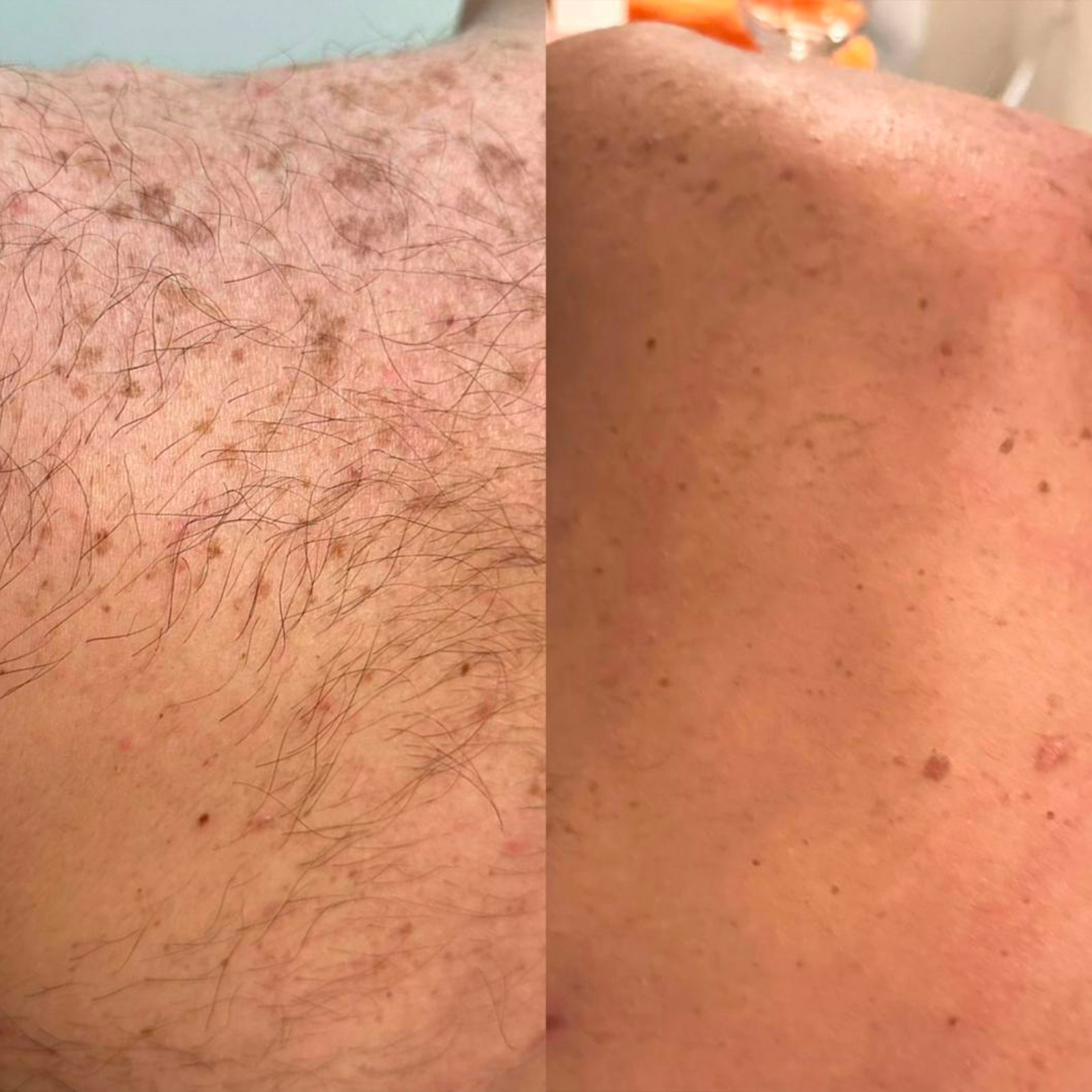 epilazionelaser-centrosuntime-primadopo02